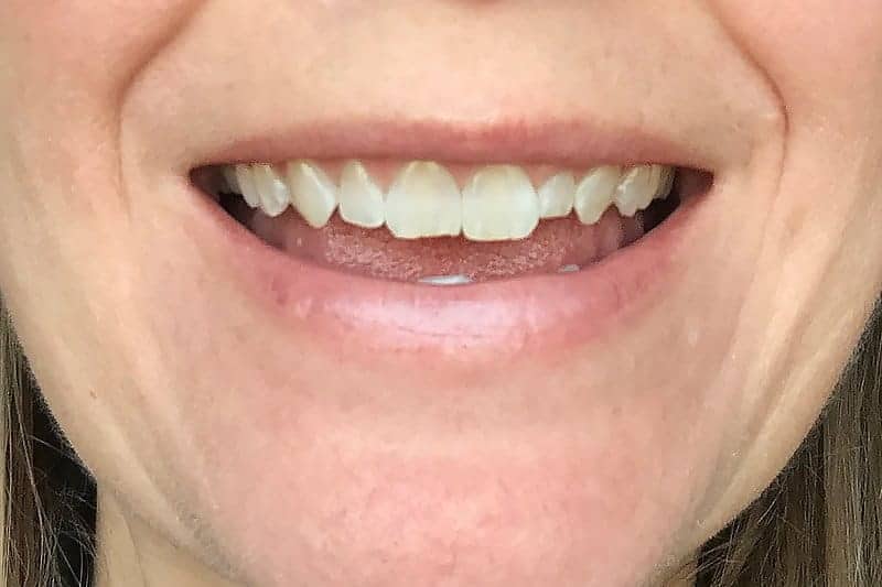 before picture of uneven teeth for veneers before and after