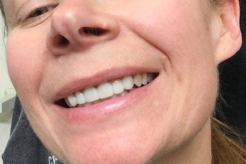 temporary porcelain veneers